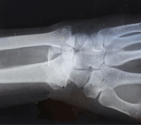 bone detection